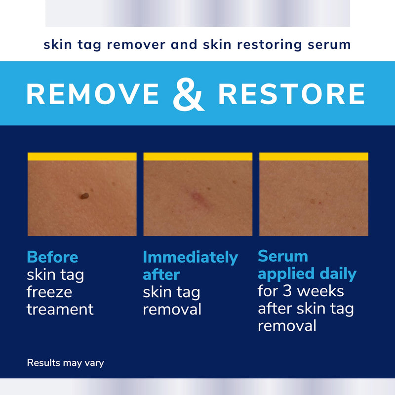 Scholl Freeze Away Skin Tag Removal Kit - Removes Skin Tags in As Little As 1 Treatment