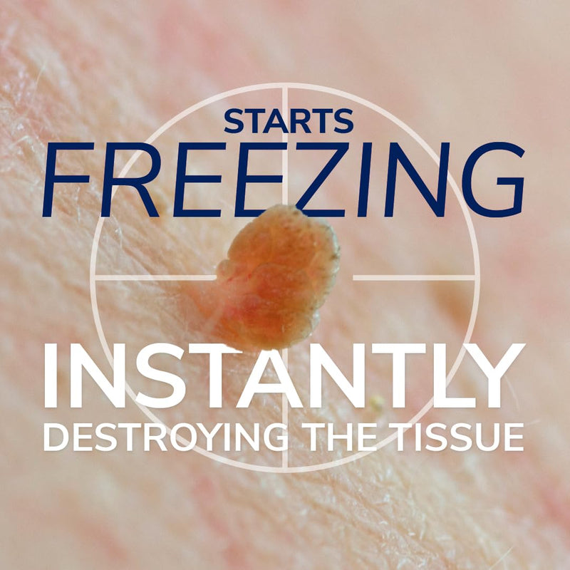 Scholl Freeze Away Skin Tag Removal Kit - Removes Skin Tags in As Little As 1 Treatment